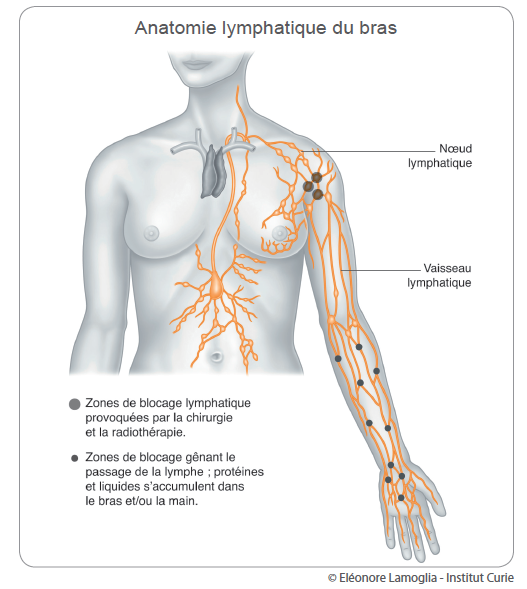 Lymph deme schema