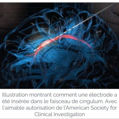 Source rire in brain