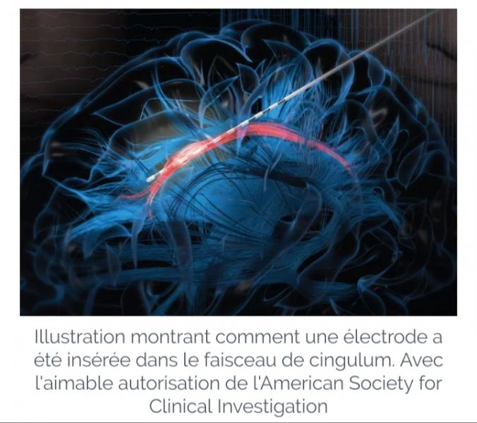 Source rire in brain